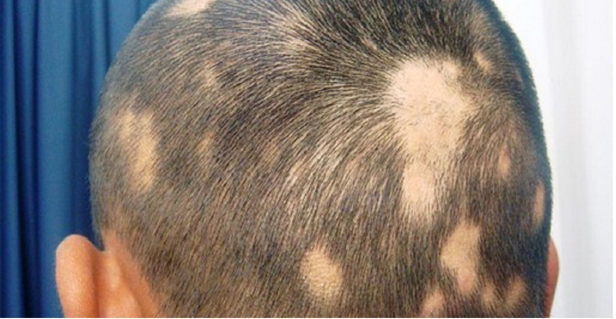 alopecia cure naturali
