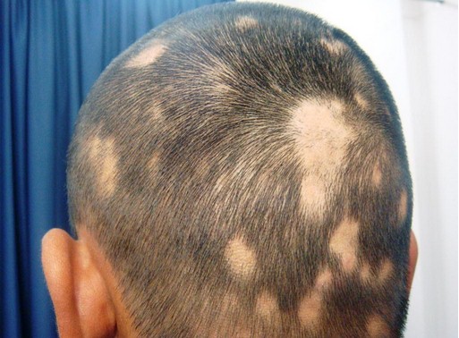 Alopecia rimedi naturali aglio